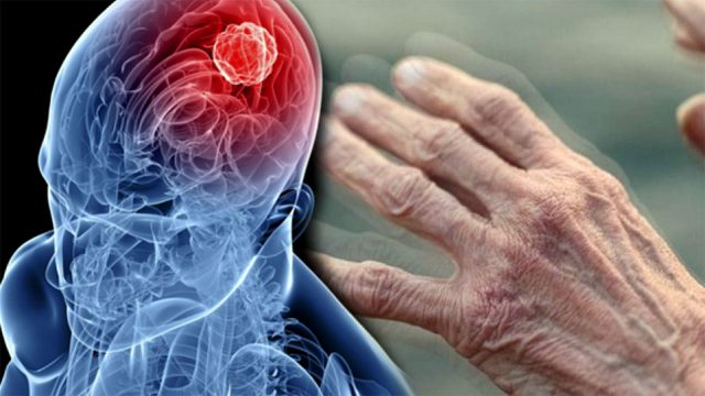 Parkinson, unutkanlık ve bilişsel değişimler